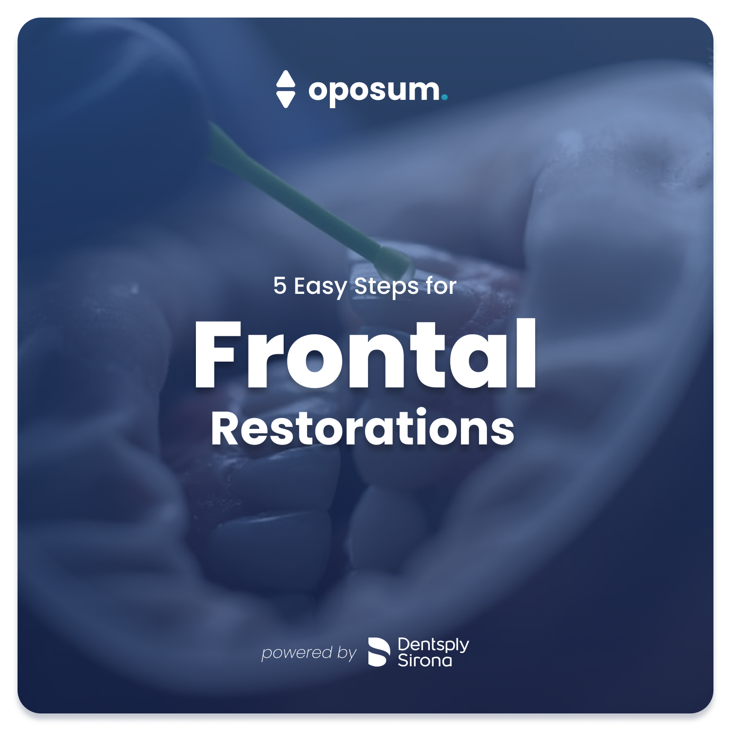 5 Easy Steps for Frontal Restorations